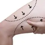 שאיבת שומן ירכיים