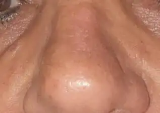 טיפולי לייזר - after treatment