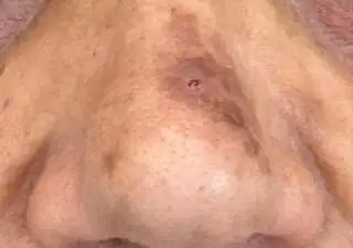 טיפולי לייזר - before treatment