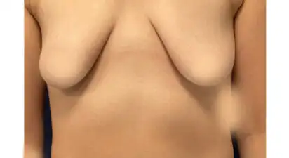 הגדלה והרמת חזה - before treatment