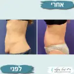 מתיחת בטן לפני ואחרי
