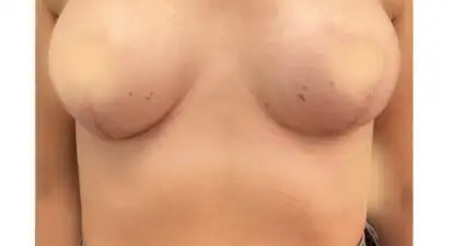 הגדלה והרמת חזה - after treatment