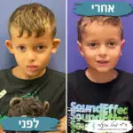 ניתוח הצמדת אוזניים לילדים