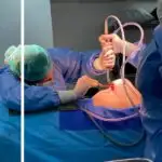 הרמת חזה עם שתל