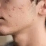 טיפול בצלקות אקנה