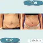 ניתוח לבטן