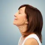 כמה זמן מחזיק ניתוח מתיחת פנים