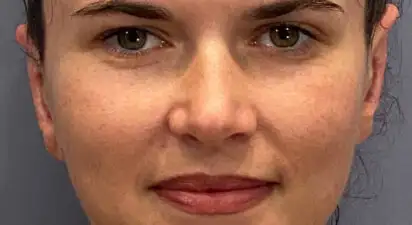 שחזור אוזניים - before treatment