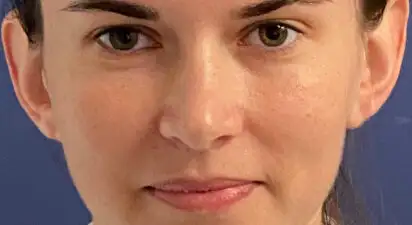 שחזור אוזניים - after treatment