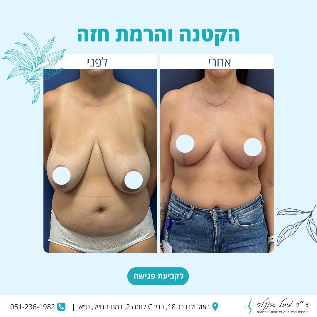 הקטנת חזה