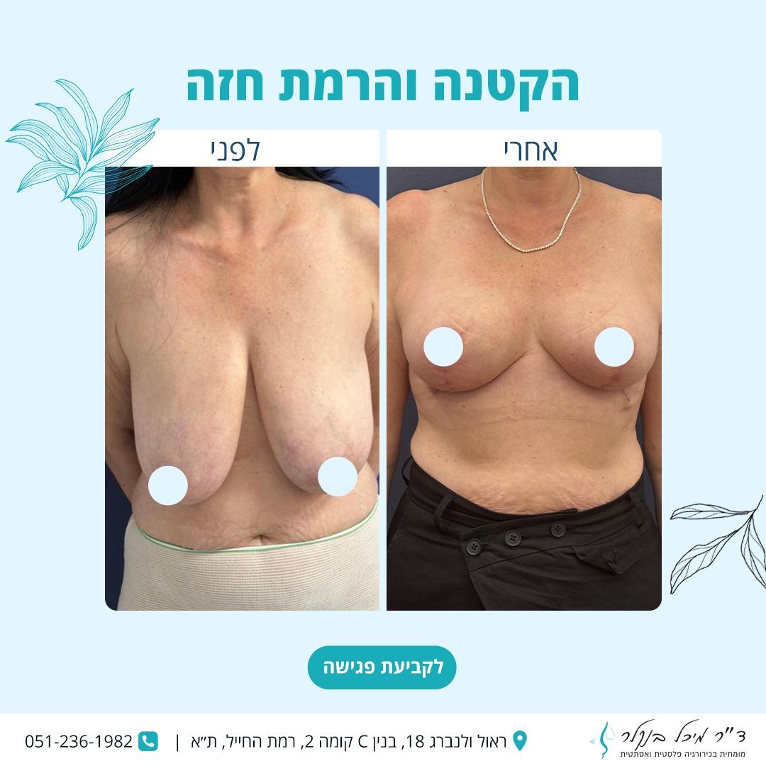 הקטנת חזה