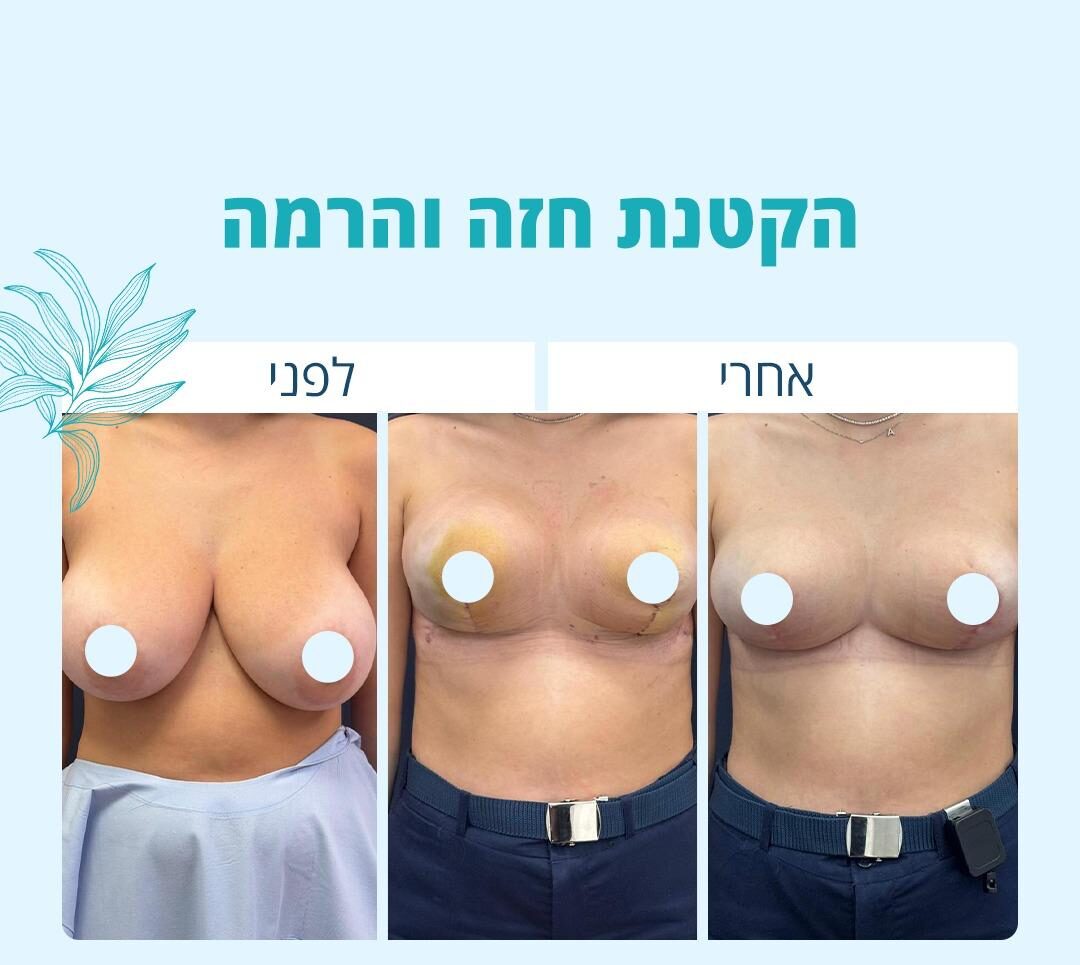 הקטנת חזה והרמה