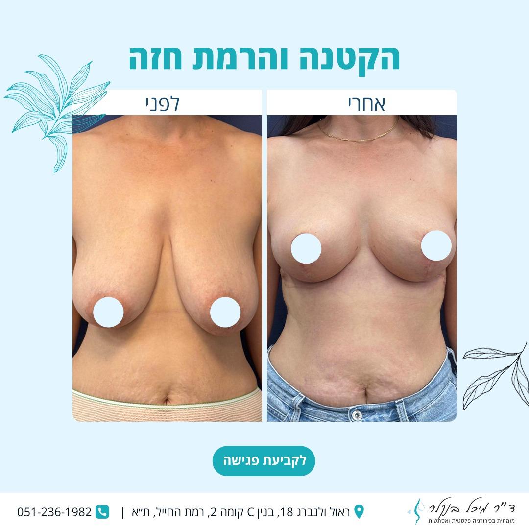 הקטנת חזה
