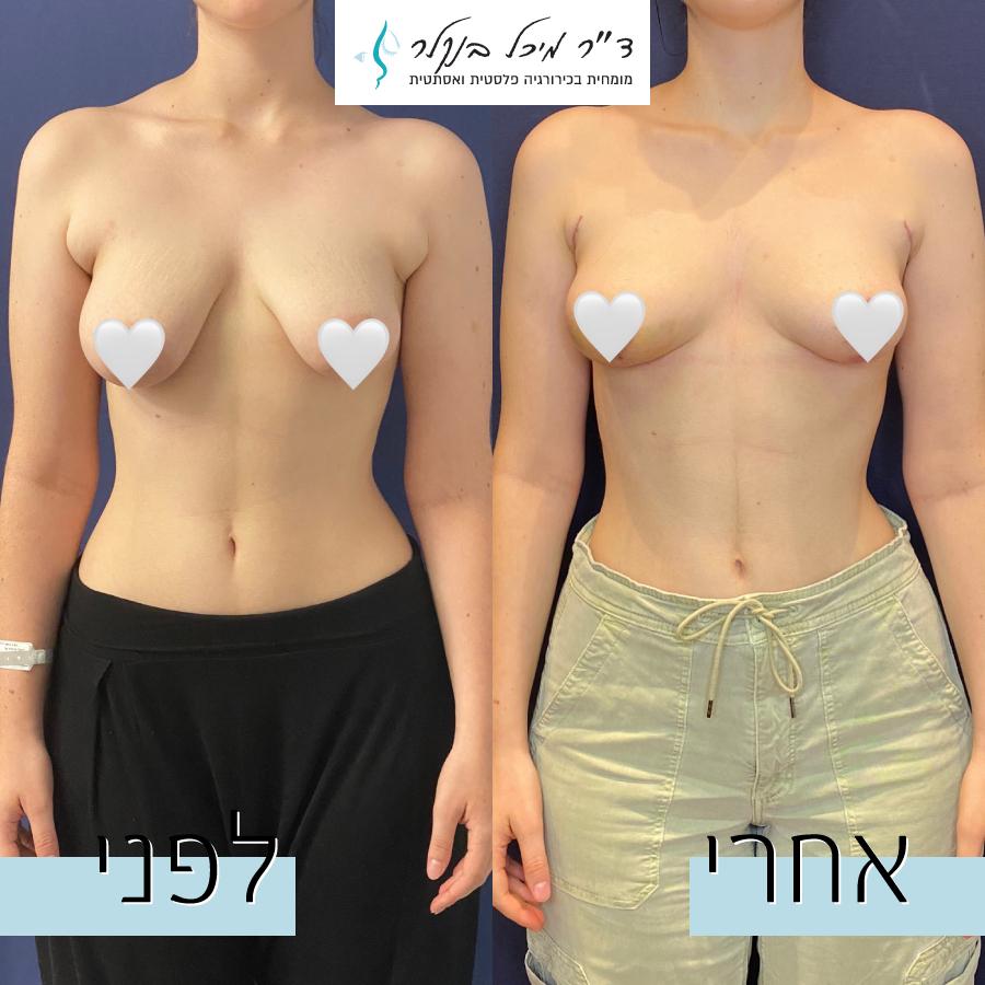 הרמת חזה