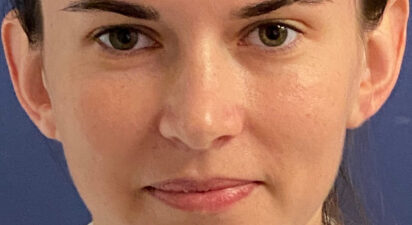 שחזור אוזניים - after treatment