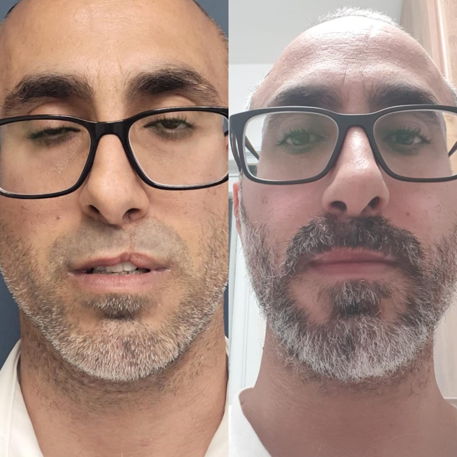 שפה שסועה