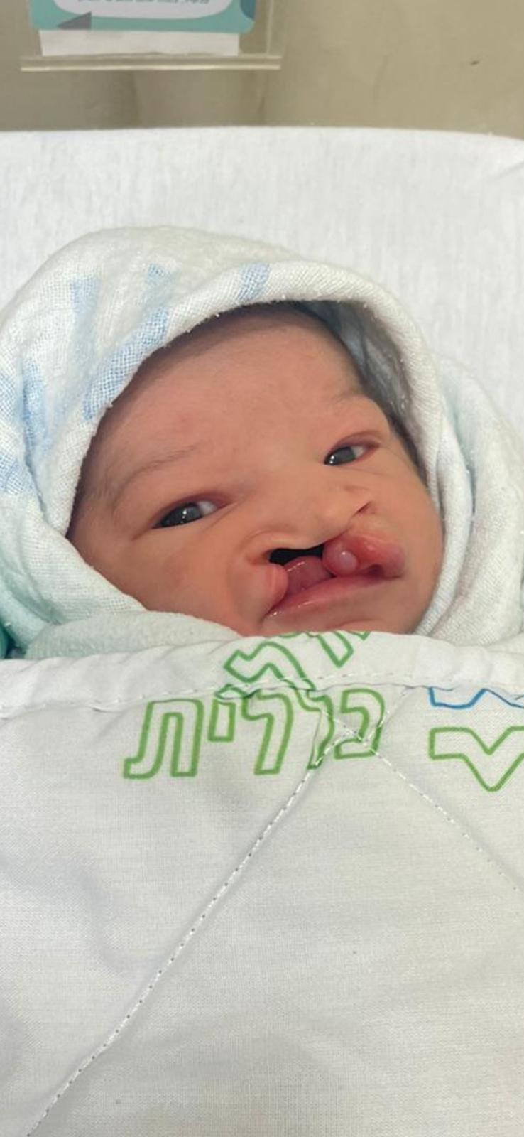 תיקון חך ושפה שסועים