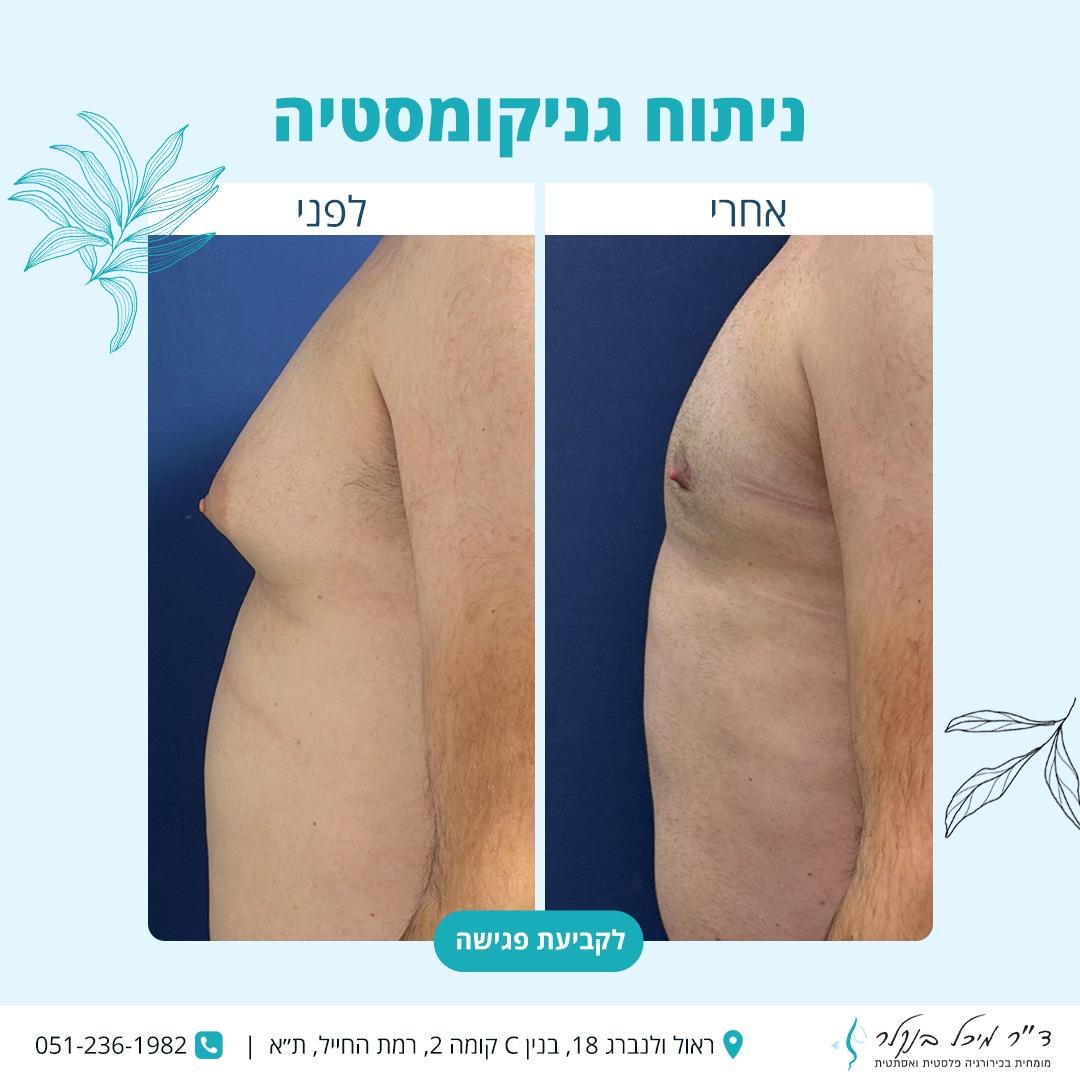 גניקומסטיה