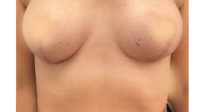 הגדלה והרמת חזה - after treatment