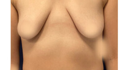 הגדלה והרמת חזה - before treatment
