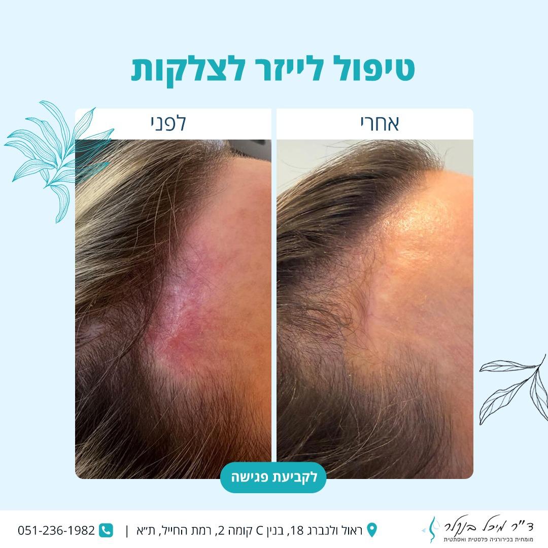 לייזר לצלקות