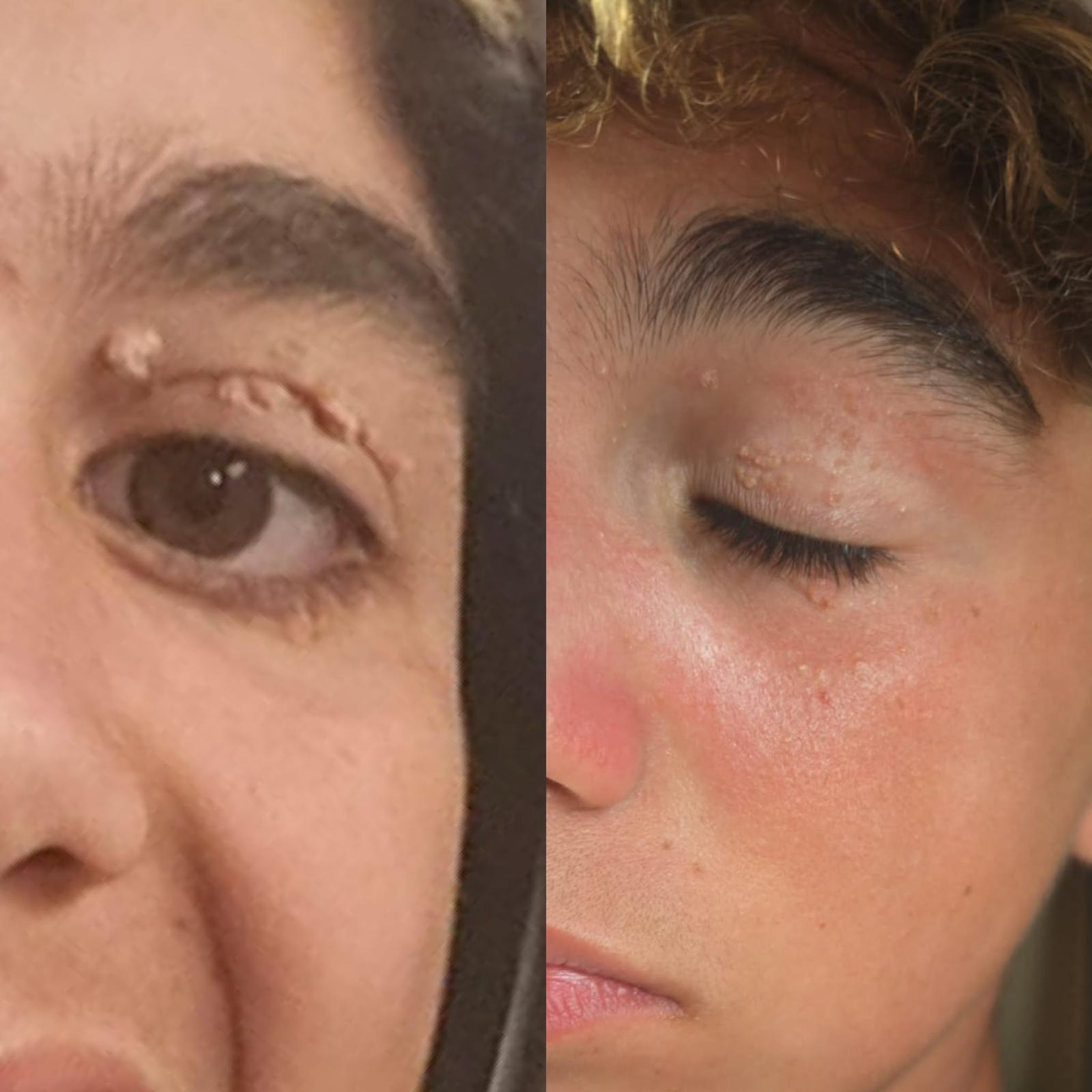 טיפול בנגעים