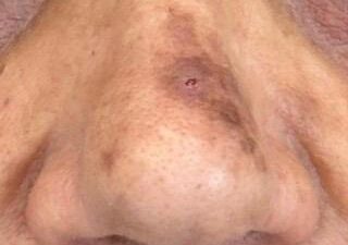 טיפולי לייזר - before treatment