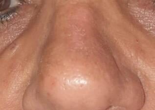 טיפולי לייזר - after treatment