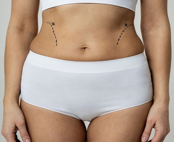 איך מתכוננים לניתוח מתיחת בטן?