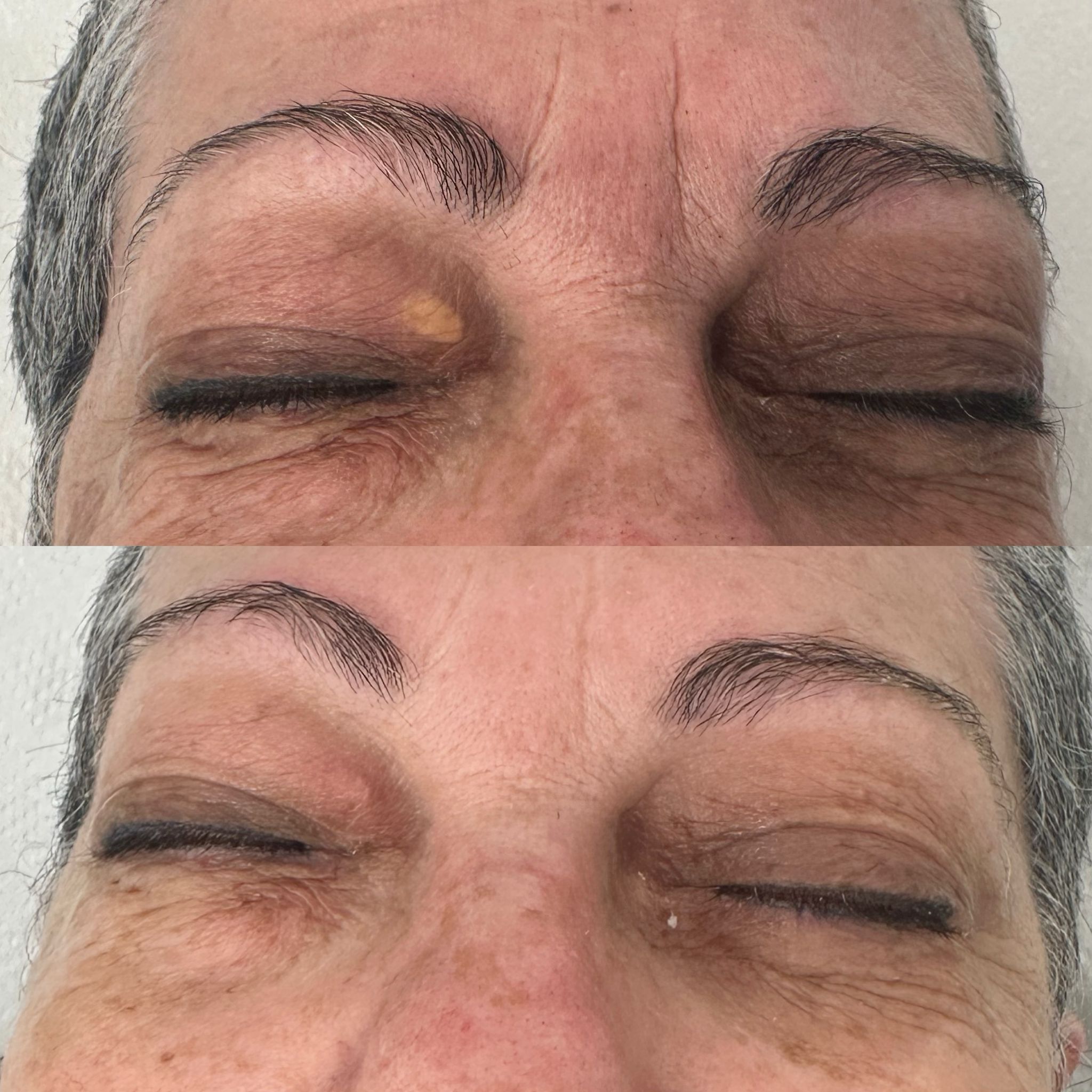 הסרת קסנטלומה ד"ר מיכל בנקלר