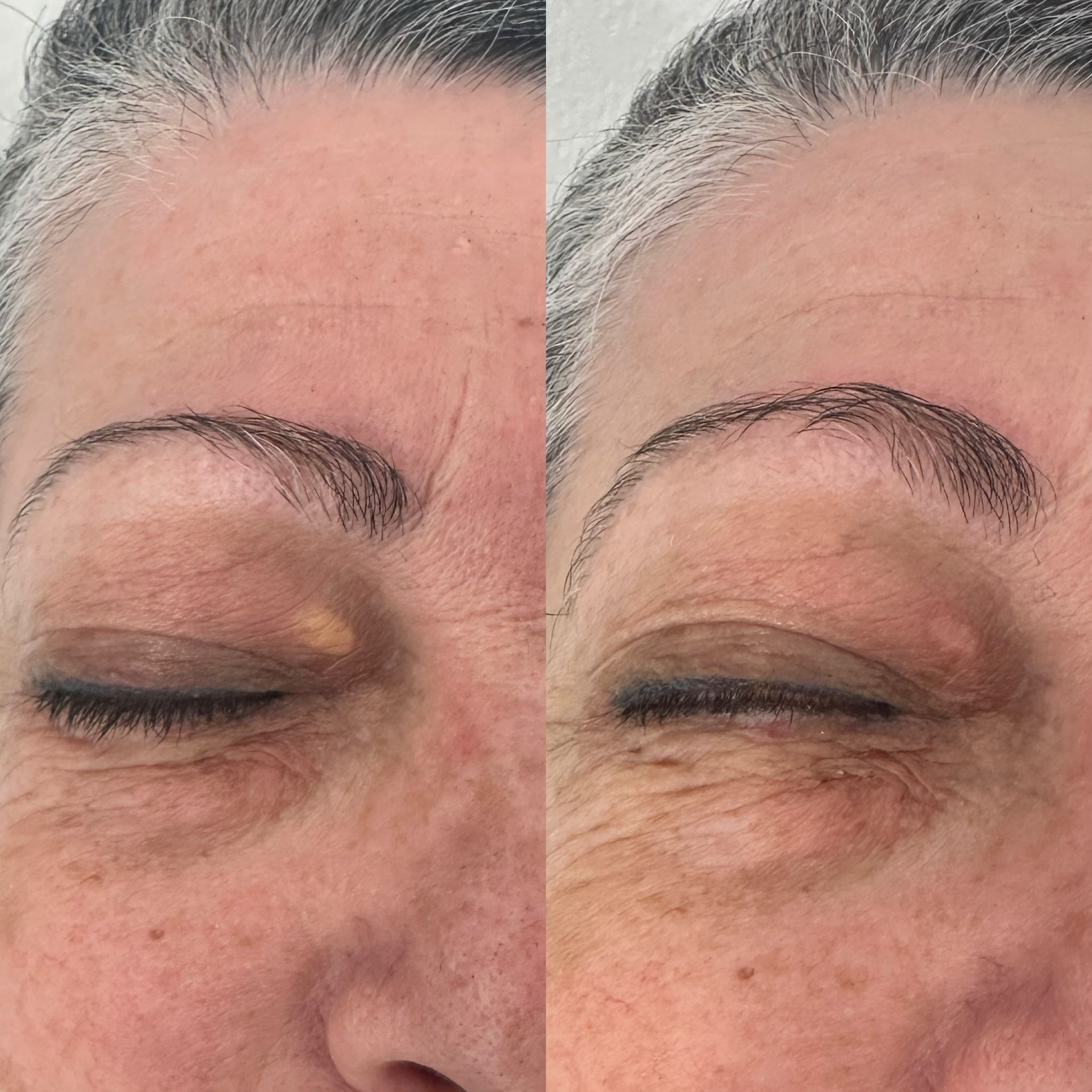 הסרת קסנטלומה בעפעפים