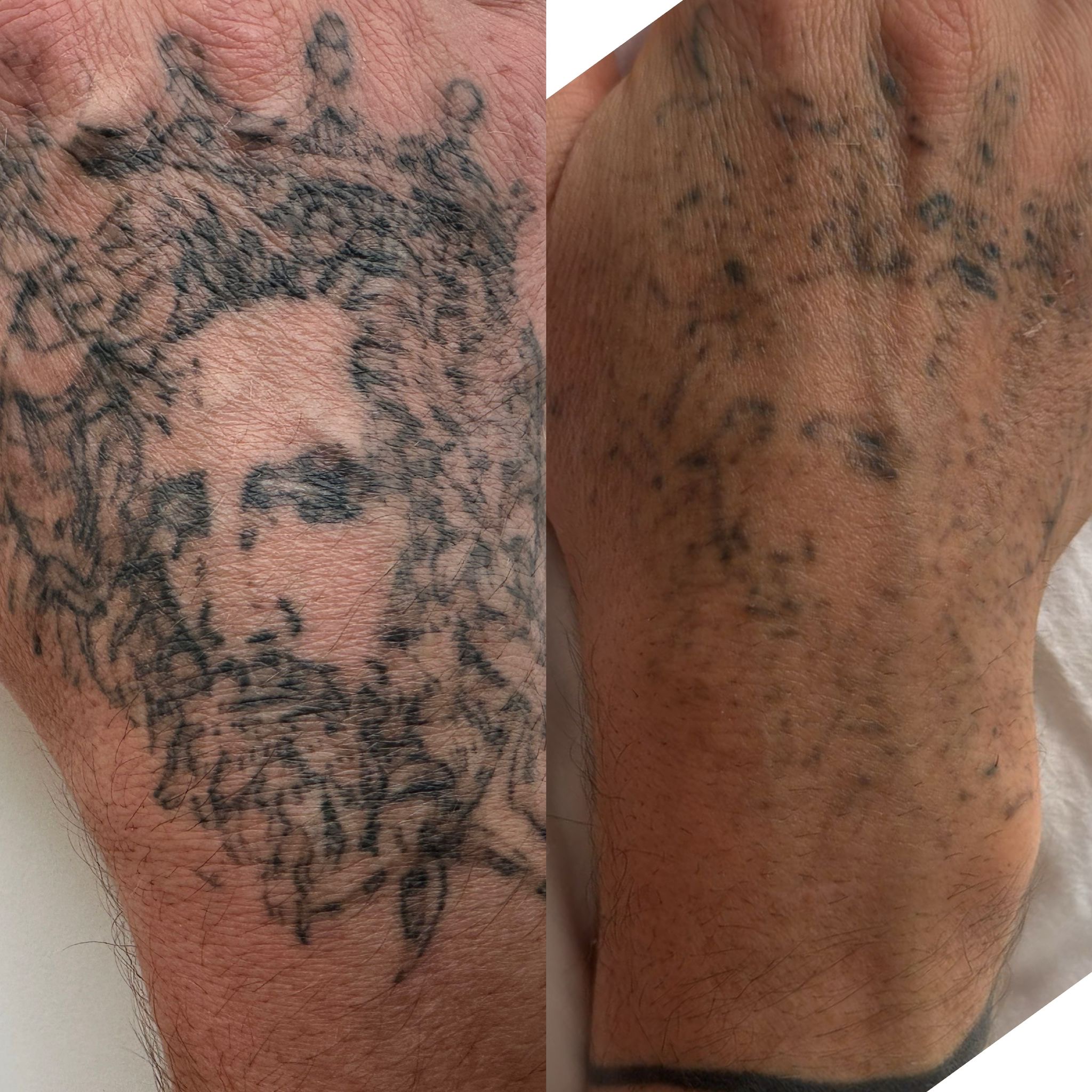 הסרת קעקועים בלייזר