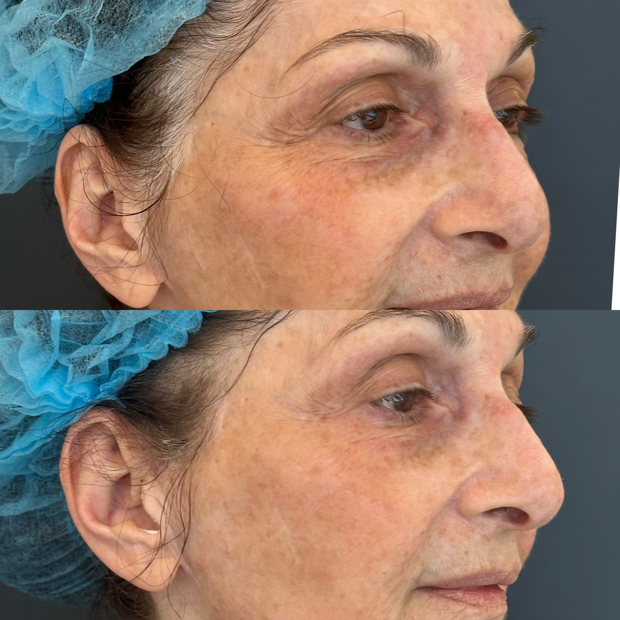 טיפול בפיגמנטציה