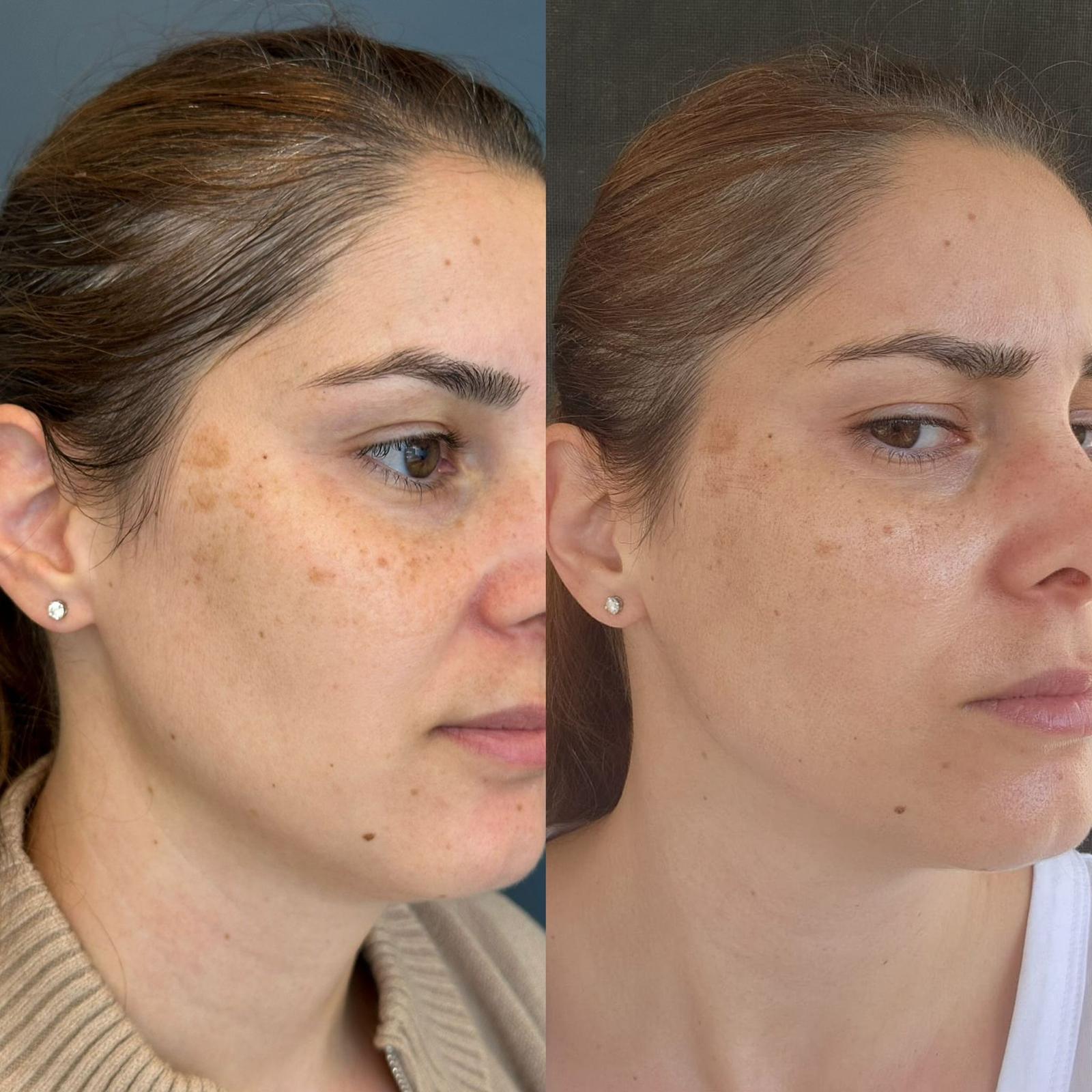 פיגמנטציה לעור הפנים