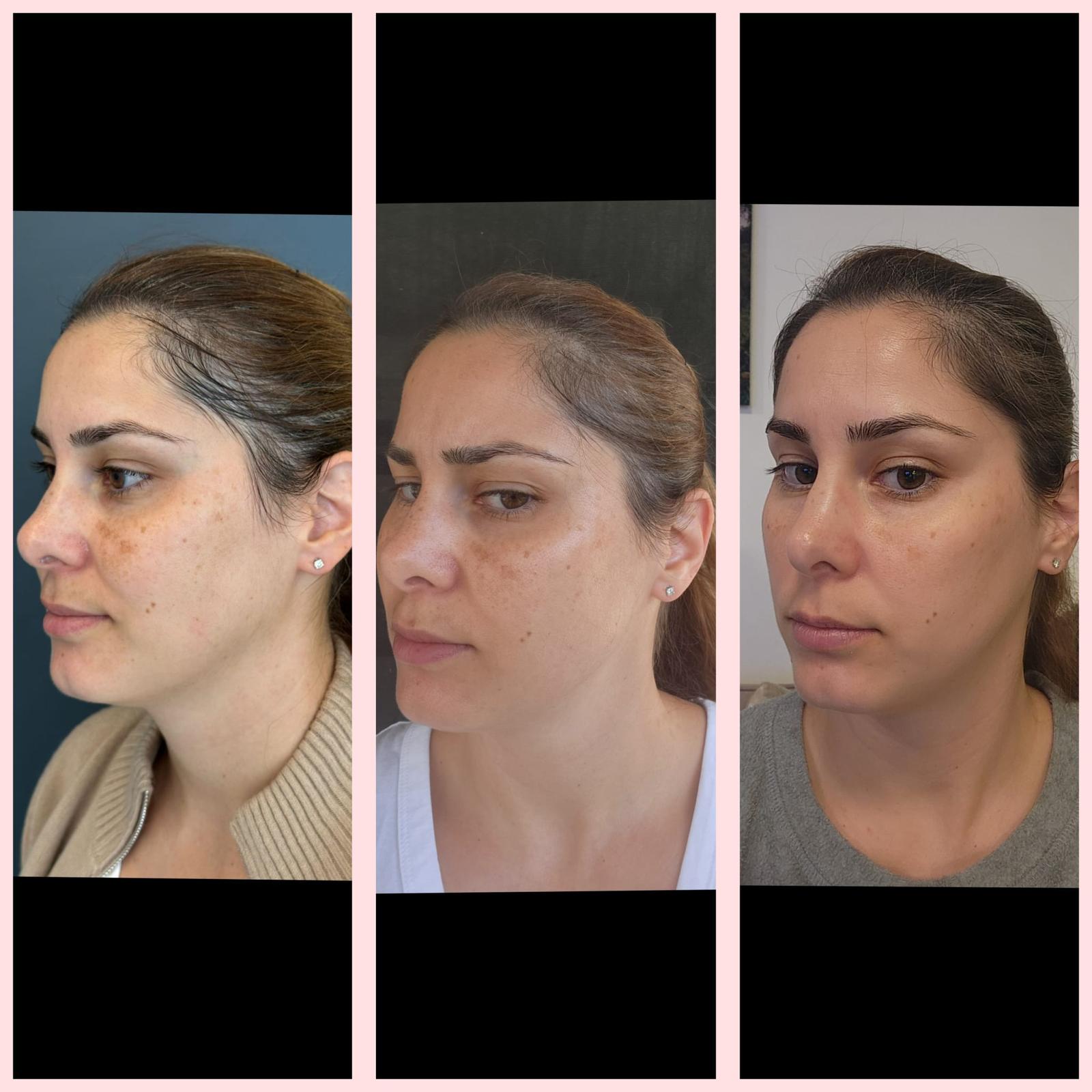 פיגמנטציה לעור