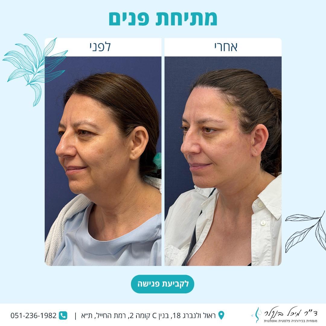 מתיחת פנים
